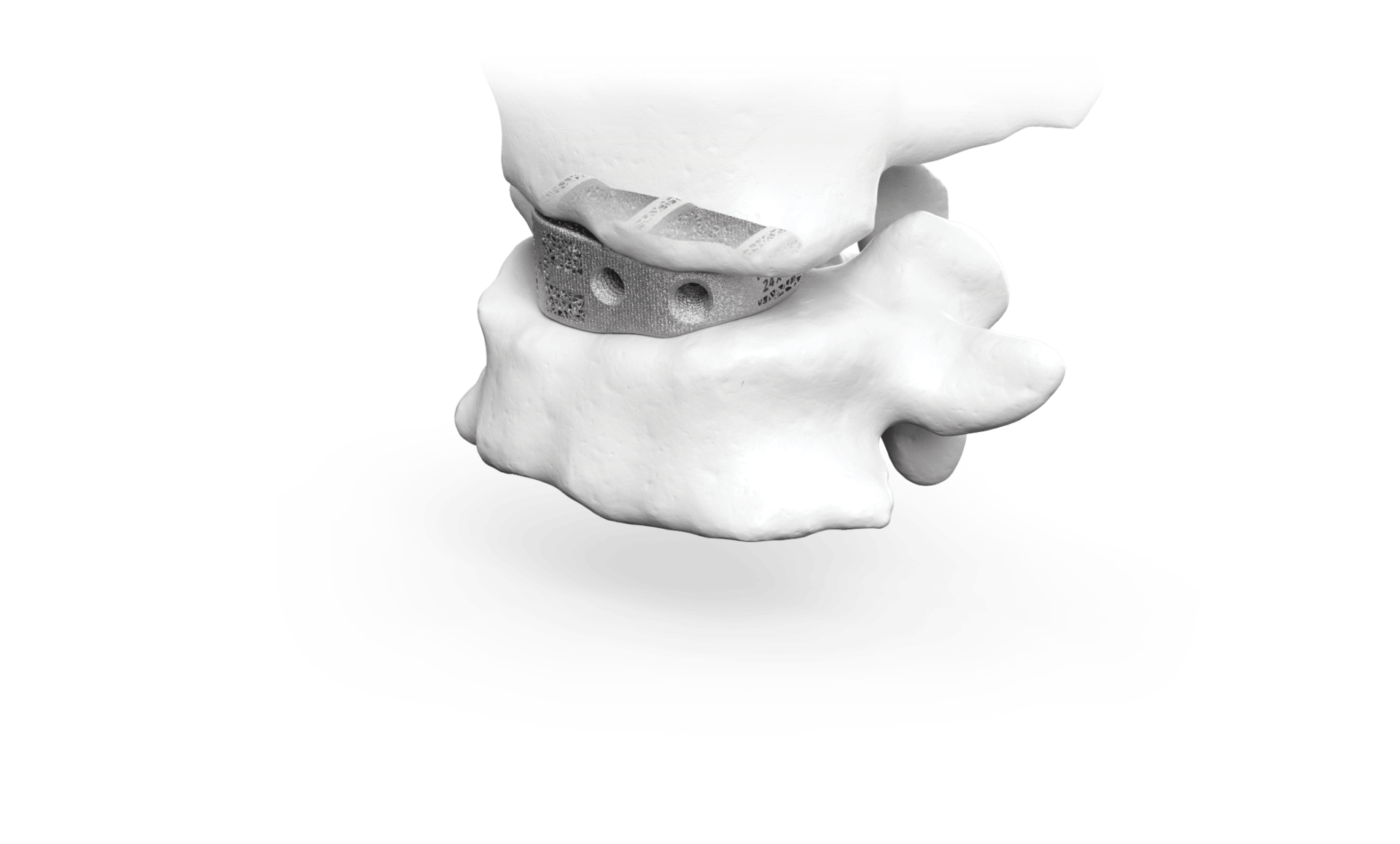 Carlsmed product rendering of an aprevo implant positioned between two lumbar vertebrae