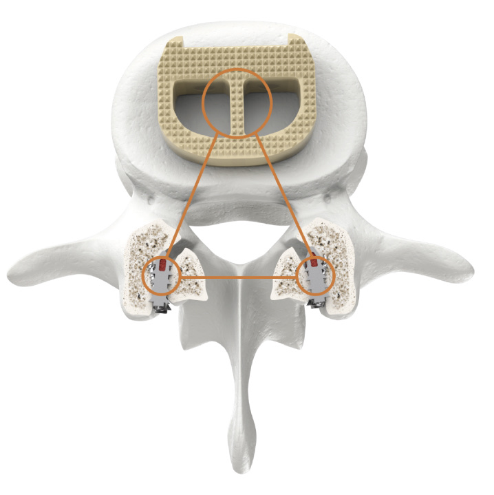 Top-down illustration of a lumbar vertebra with an interbody cage in the disc space and a CORUS-LX implant in each facet joint, connected by an orange triangle marking three points of fixation