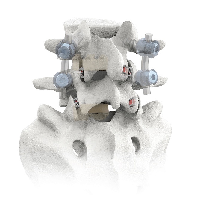 Illustration of the lower lumbar spine from behind with pedicle screws and rods at one level and small CORUS-LX implants seated in the facet joints at the levels below