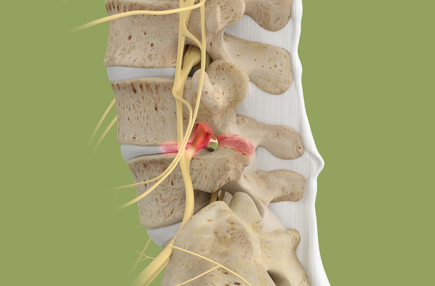 Side view of the lumbar spine with red highlighting around a degenerated disc and the joints behind it; yellow structures show the nerves