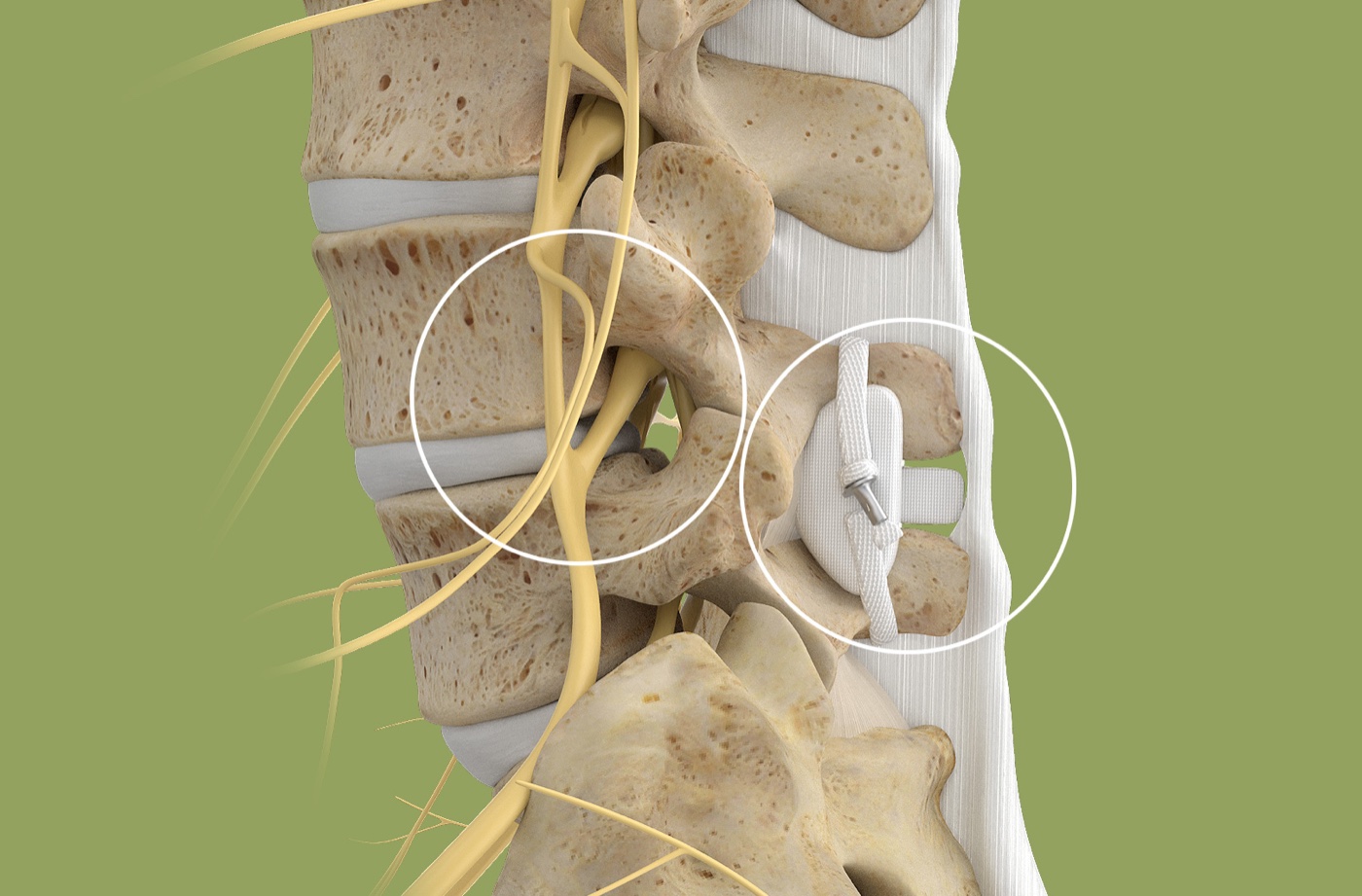 DIAM positioned between two spinous processes at the back of the lumbar spine; white circles identify the implant and the nearby nerve opening