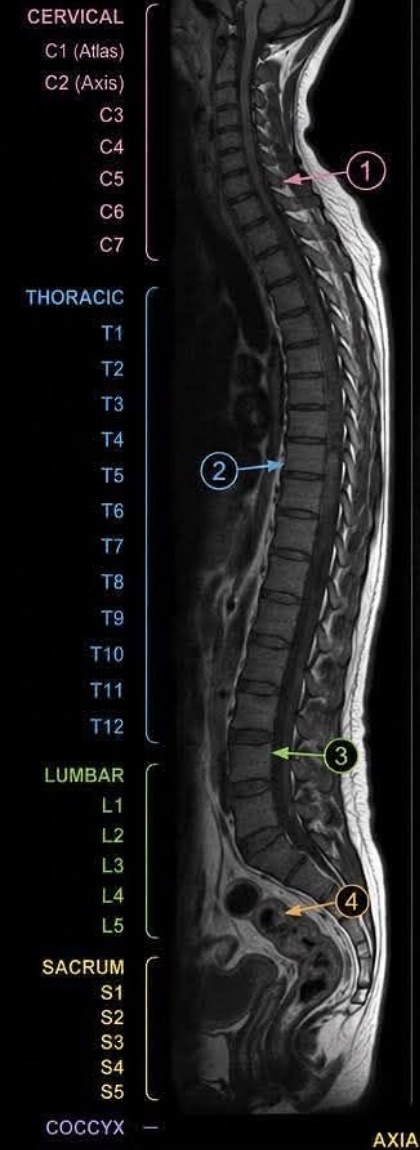 Sagittal MRI of the entire spine with labeled levels from C1 to the coccyx and four numbered findings