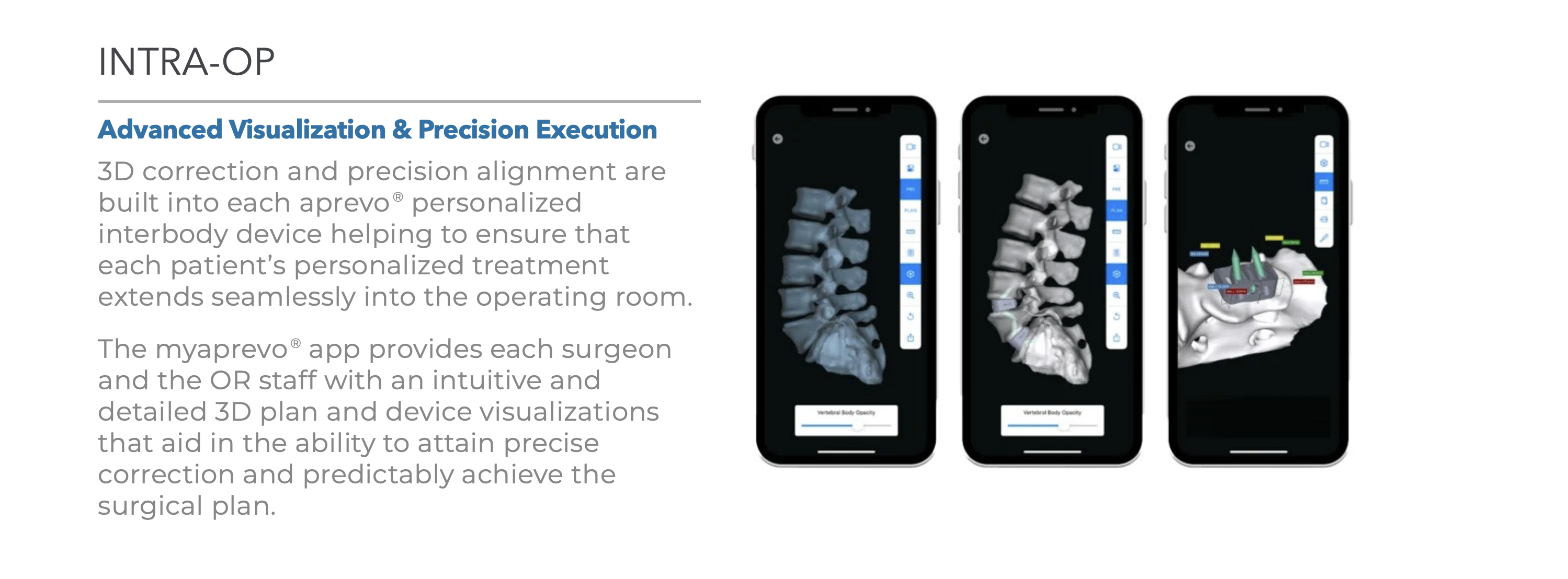 Intra-op myaprevo app shown on three phones, displaying interactive 3D plan and device visualizations of the spine for precise surgical execution.