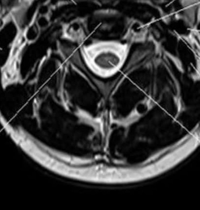 Axial (cross-section) MRI of the cervical spine showing the spinal cord, vertebral body, facet joints, and vertebral arteries