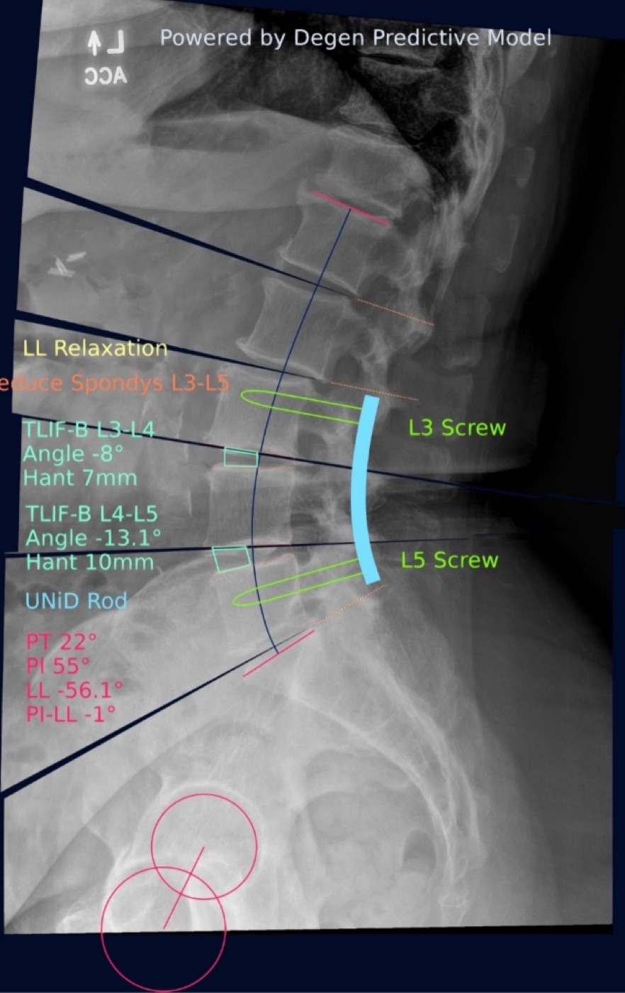 Standing fluoroscopy image with the planned alignment, screw levels, and pelvic measurements drawn on it