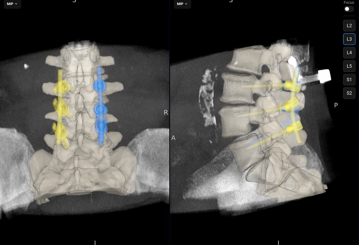 Three-dimensional reconstruction of the lumbar spine from the intraoperative O-arm scan with planned screws shown in yellow and blue