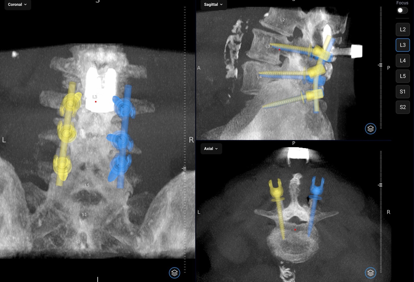 Coronal, sagittal, and axial views of the planned screw trajectories on the intraoperative scan