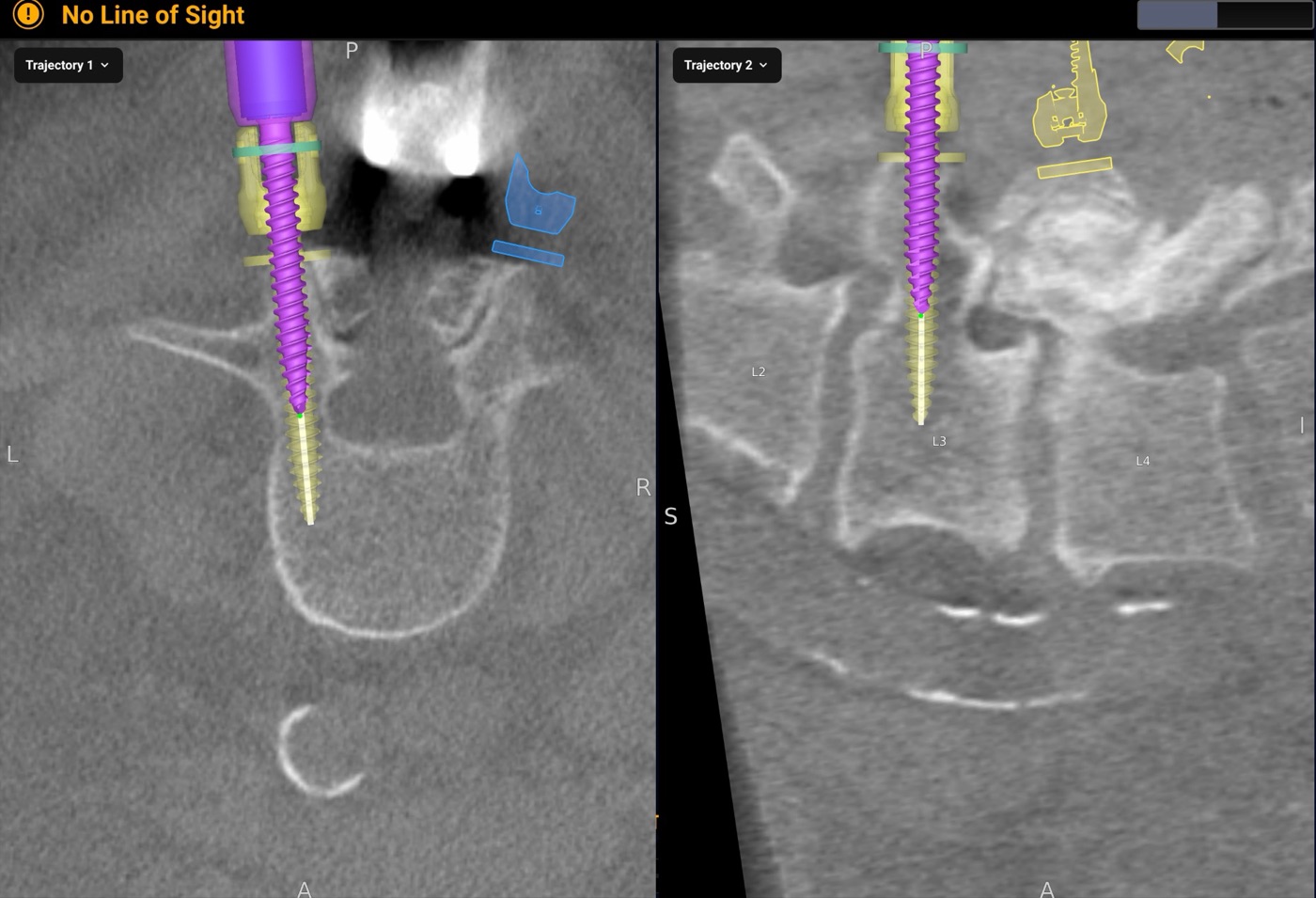 Navigation screen showing the placed L3 screw overlaid on the live scan