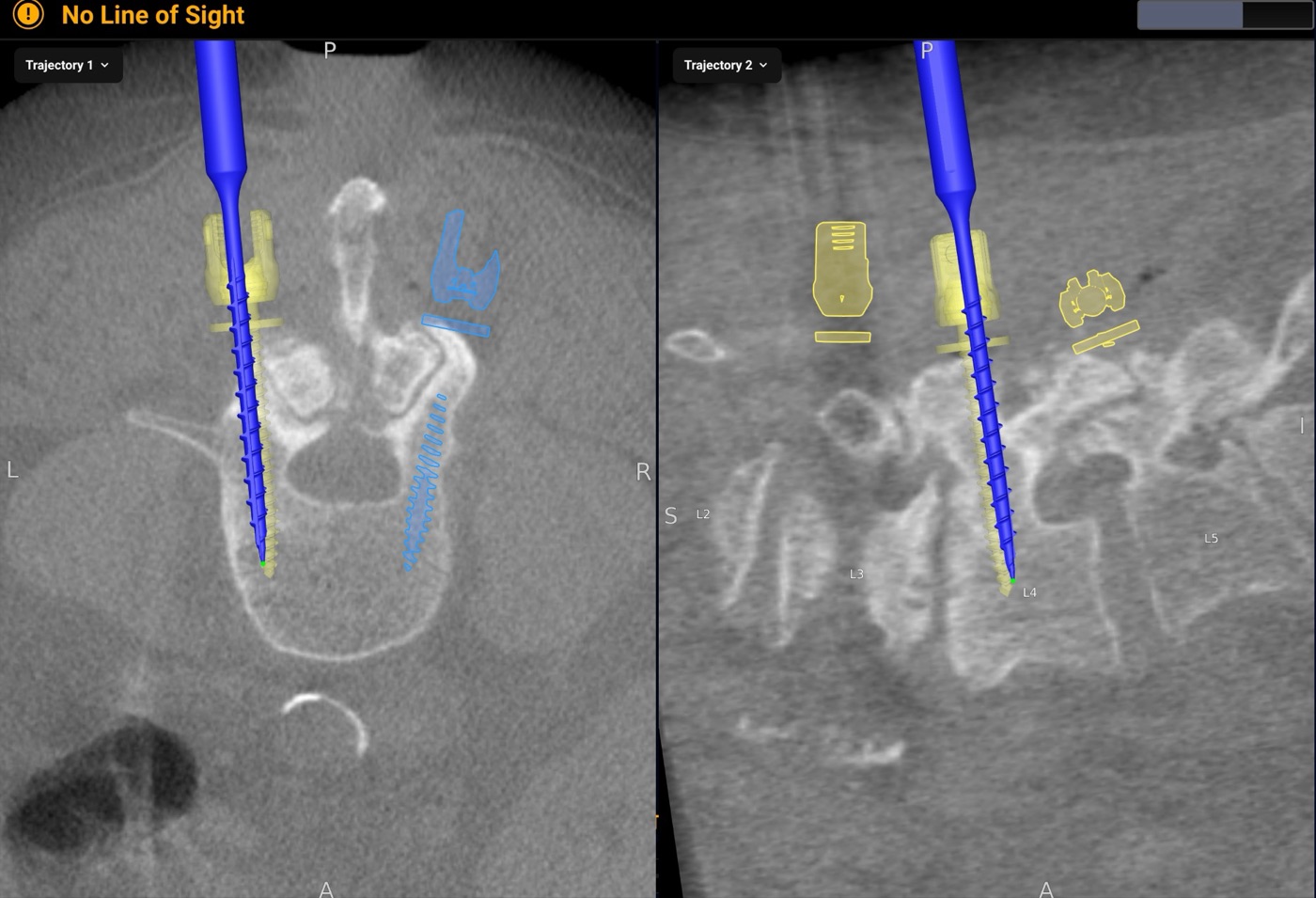 Navigation screen showing both L5 screws in place on the axial and sagittal views