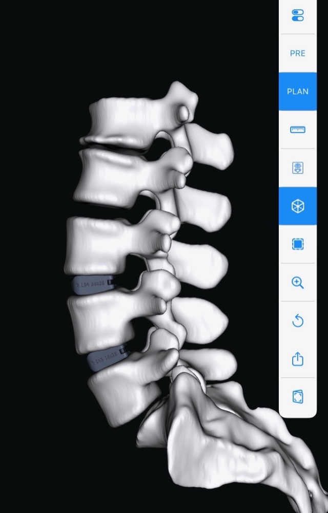 3D surgical plan from the myaprevo app showing patient-specific interbody implants placed between the vertebrae