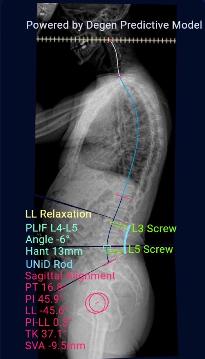 AI-driven predictive surgical planning model showing planned spinal alignment, UNiD rod, and L3/L5 screw placement