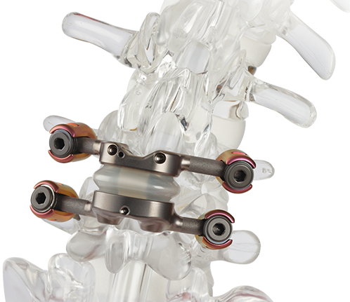Premia Spine TOPS implant on a spine model