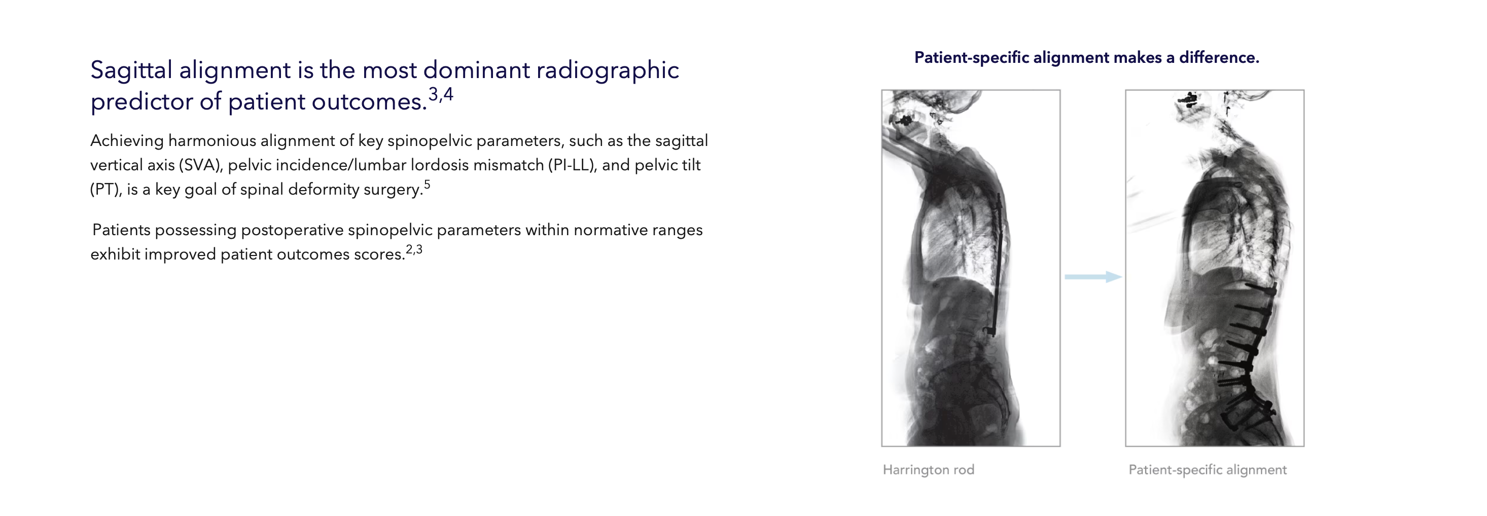 X-ray comparison showing a Harrington rod versus patient-specific alignment, illustrating that achieving normative spinopelvic parameters (SVA, PI-LL, PT) improves outcomes.